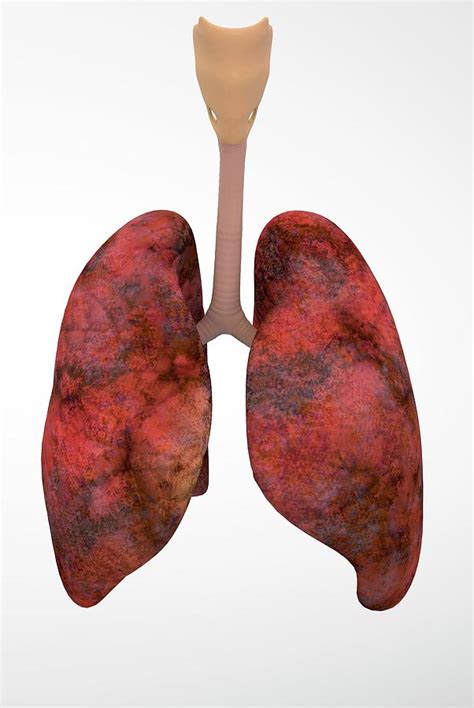 Smoker's Lungs Photograph by Ella Maru Studio / Science Photo Library - Pixels