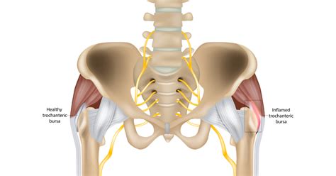 The Ultimate Guide - Treatment for Bursitis in the Hip