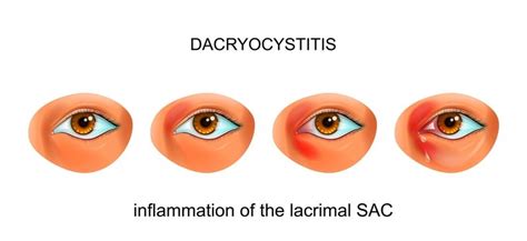 Tear Duct Infection (Dacryocystitis) - Harvard Health | Tear duct, Tear duct infection, Upper eyelid