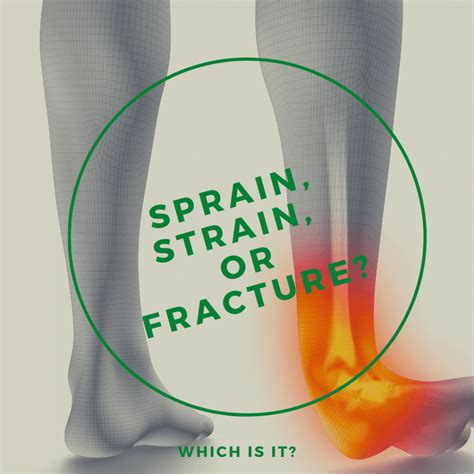 Sprain, Strain, or Fracture: Which is It? | Alternative Health Center ...