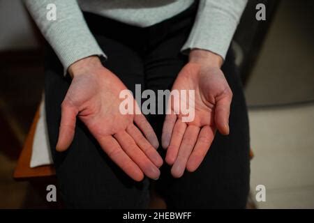 Hands of person with Raynaud syndrome with palms up after attack, affected part turning blue ...