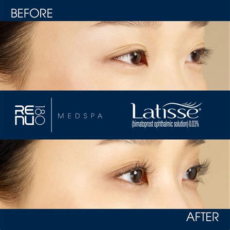 Latisse Eyelash Growth Serum vs. Eyelash Extensions | Re:nu 180