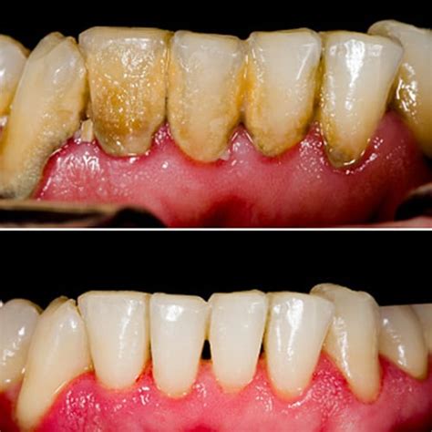 Gingival Inflammation: Scaling | Colgate® Professional