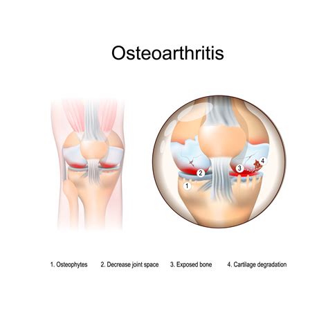 Arthritis Knee Pictures | Arthritis Knee Pain Center