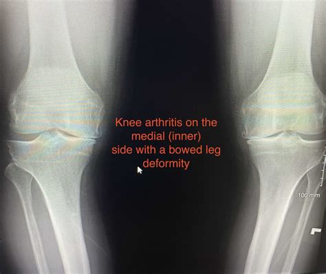 Osteoarthritis Knee Xray