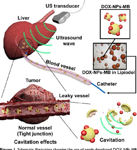 Figure 1 from Development and evaluation of an ultrasound-triggered microbubble combined ...