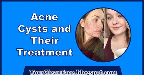 Acne Cysts and Their Treatment