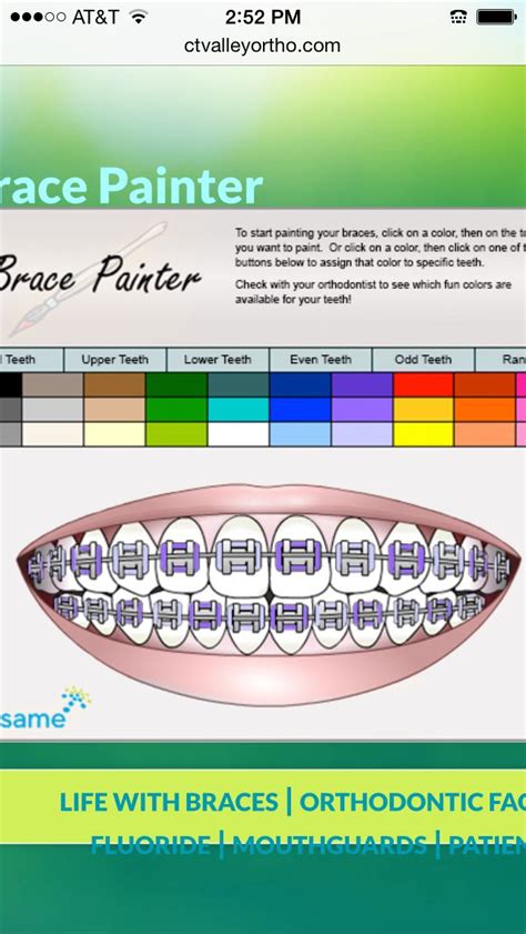 Lavender braces | Braces colors, Cute braces colors, Braces