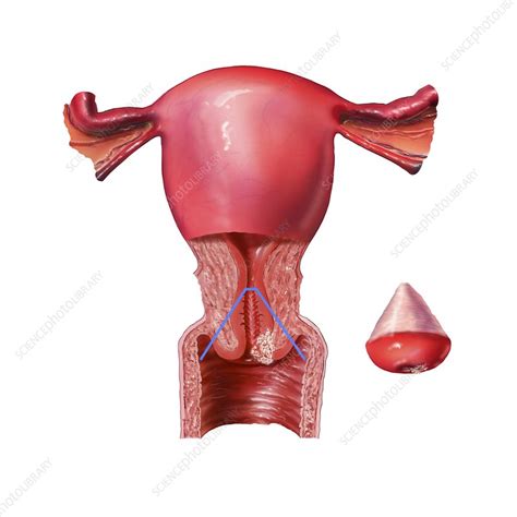 Cervical conization, artwork - Stock Image - C007/6933 - Science Photo ...