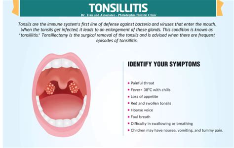 Treatment of Tonsillitis - Philadelphia Holistic Clinic - Dr. Tsan ...