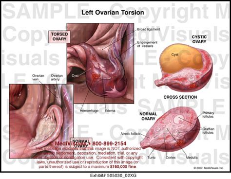 Left Ovarian Torsion Medical Illustration