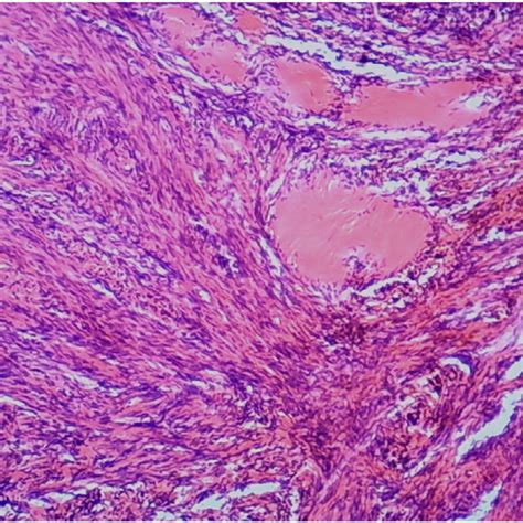 Foci of hemosiderin deposition are characteristic (HE staining, ×100). | Download Scientific Diagram