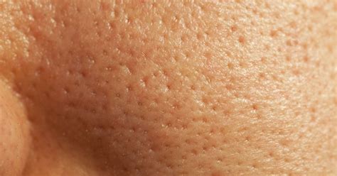 How to get rid of large pores: The top 8 ways