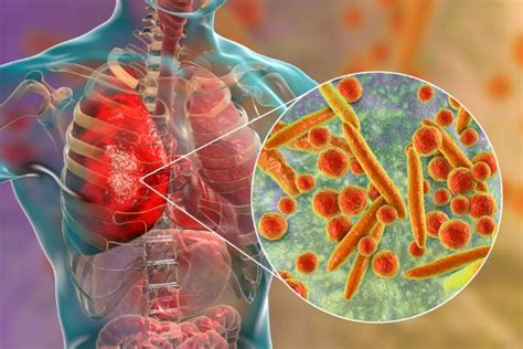 Understanding Mycoplasma Hominis: Causes, Symptoms, and Treatment