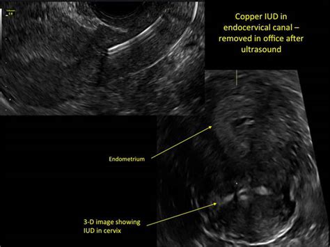 How to identify and localize IUDs on ultrasound | MDedge ObGyn