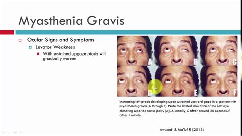 Myasthenia Gravis Symptoms