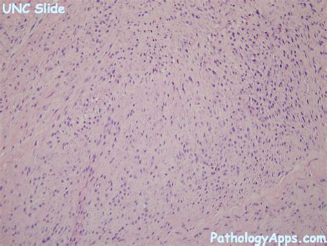 superficial fibromatosis soft tissue histology