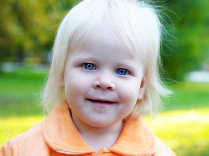 Albinism - symptoms, Definition, Description, Demographics, Causes and symptoms, Diagnosis ...