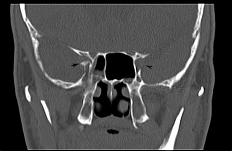 Radiodiagnosis - Imaging is Amazing-Interesting cases: Traumatic optic ...