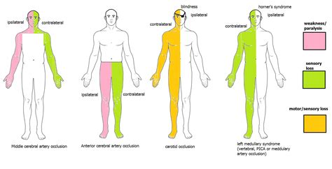 PLAB king: Right sided weakness, left sided blindness (64/1700)