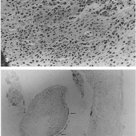 Inflamed granulation tissue which constituted much of the lesion (H ...