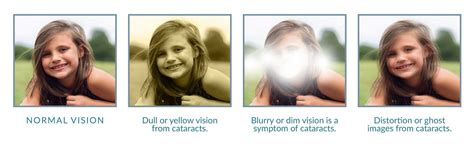 Cataract Causes and Treatment - Piedmont Eye Center