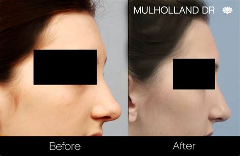 Rhinoplasty for Bulbous Nose Tip: Causes & Treatment