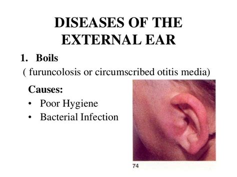 Common Ear Diseases