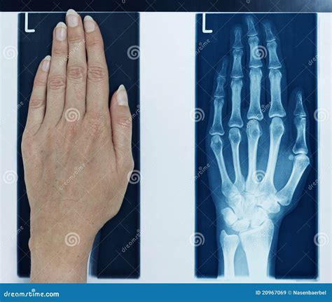 X-ray Picture Left Hand Royalty Free Stock Images - Image: 20967069