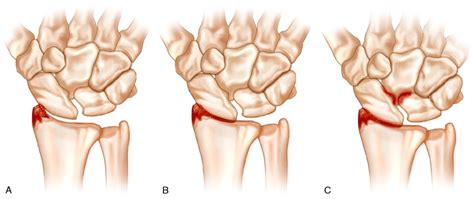 SLAC and SNAC Wrist | Musculoskeletal Key