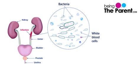 Urinary Tract Infection During Pregnancy - Causes, Symptoms and ...