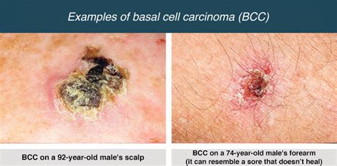 Basal cell carcinoma – skin cancer | healthdirect