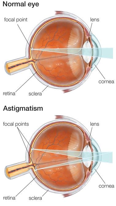 Astigmatism Correction Specialists · Top Eye Doctors · Ophthalmologist NYC