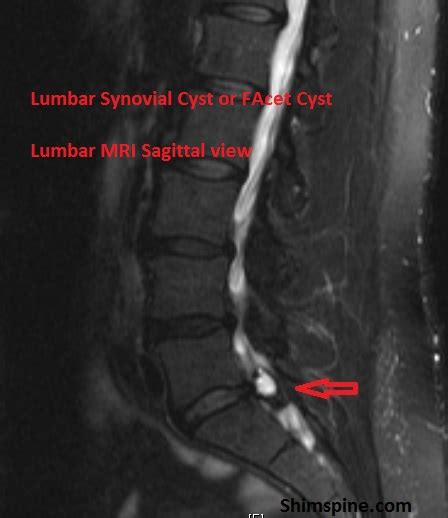 Lumbar Synovial Cysts - ShimSpine