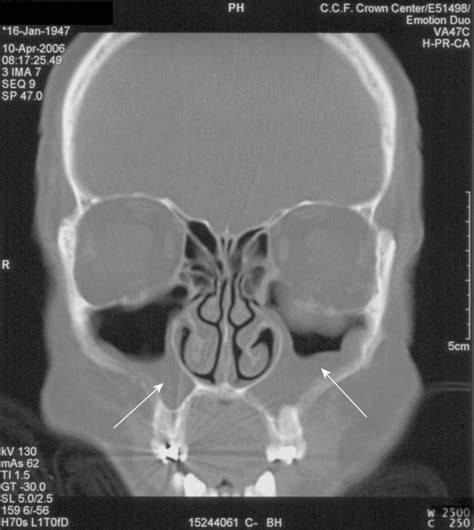 Maxillary Sinus Infection