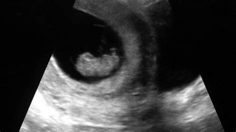 The Dating Ultrasound at 9 weeks to determine the due date of the baby