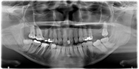 Case of the Week: Talon Cusp – Dr. G's Toothpix