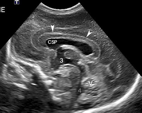 Third Ventricle Neonatal Ultrasound | Images and Photos finder