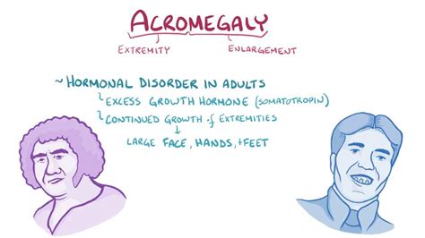 Acromegaly - Osmosis Video Library