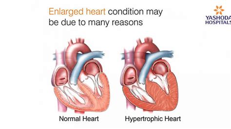 Understanding Heart Disease Anatomical Wall Chart AnatomicalStore 2023 | lupon.gov.ph