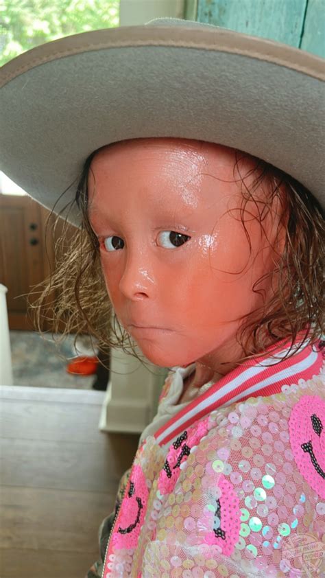 Harlequin Ichthyosis Child Model | Media Drum World