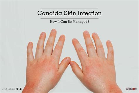 Candida Skin Infection - How It Can Be Managed? - By Dr. V.Sethu Raman ...