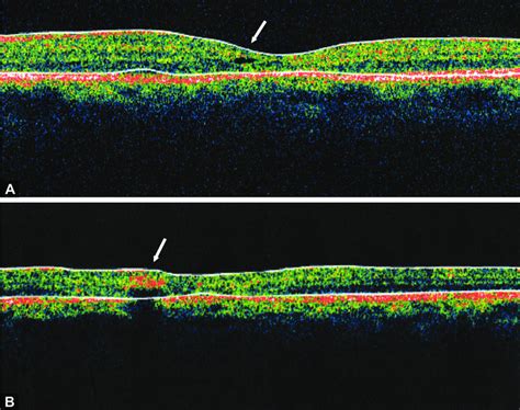 (A) Optical coherence tomogrpahy scan at the fovea demonstrating a ...