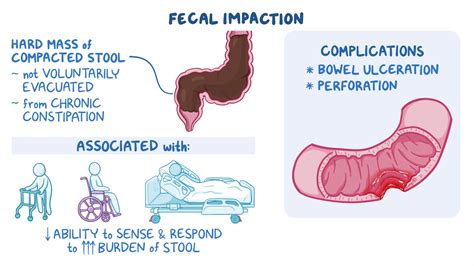 Fecal impaction: Clinical sciences - Osmosis Video Library