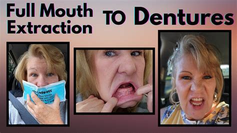 Dentures & Full Mouth Extraction Progress From Day one With Dentures / 5 Month Denture Update ...