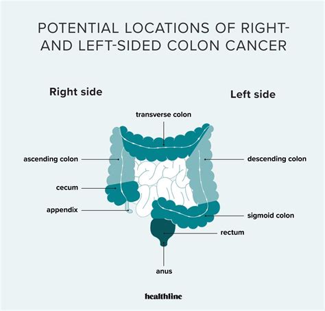 Right-Sided Colon Cancer: Symptoms, Pain Location, and Outlook