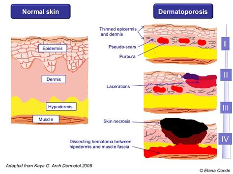 Wounds secondary to dermatoporosis or chronic cutaneous insufficiency