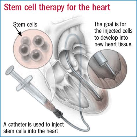 Stem cells to repair heart damage? Not so fast - Harvard Health