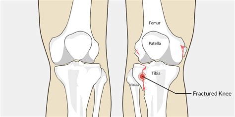 Fractured Knee - The Complete Injury Guide - Vive Health