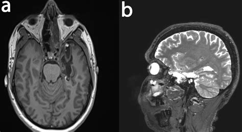 Epilepsy-Surgery-Through-the-Face--An-Anatomical-Study-and-Early-Clinical-Results-of-the ...